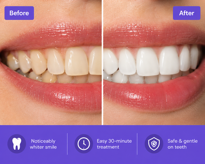Purple Whitening Strips